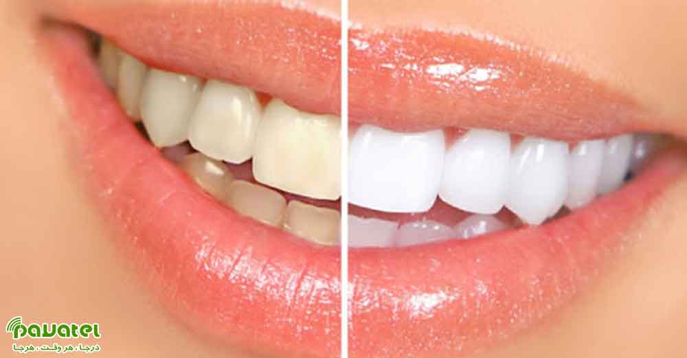 سفید کردن دندانها در فتوشاپ